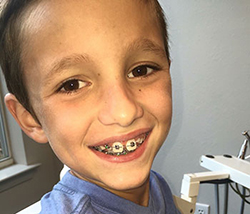 early orthodontic treatment